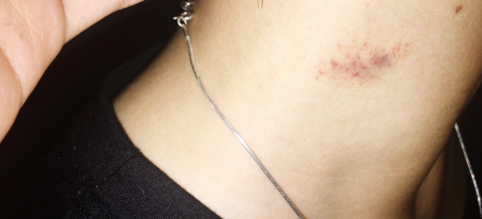 Boyunda Morluk (Hickey) Nasıl Oluşur ve Ne Kadar Sürede Geçer?