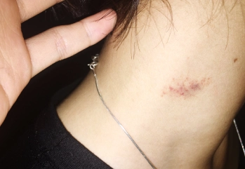 Hickey Nedir Nasıl Oluşur
